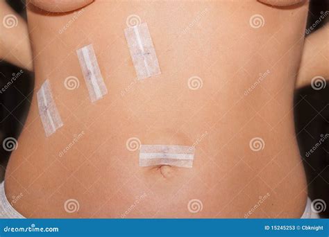 Gall Bladder Surgery stock image. Image of post, tape - 15245253