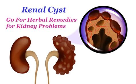 Renal Cyst – Go For Herbal Remedies for Kidney Problems | Kundan Kidney ...