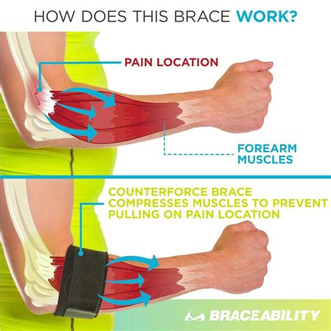 LATERAL EPICONDYLAGIA (TENNIS ELBOW) – Physio For You