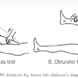 Positive Psoas and Obturator Signs [64]. | Download Scientific Diagram