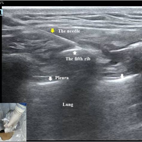 Ultrasound guided Serratus anterior block procedure. | Download ...