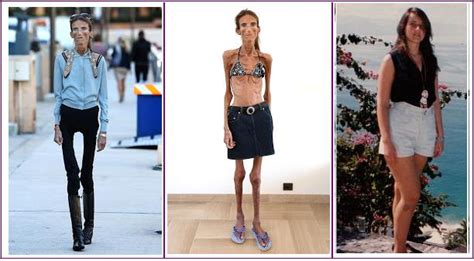 Shocker!!! Meet the thinnest woman in the world: Anorexic Valeria ...