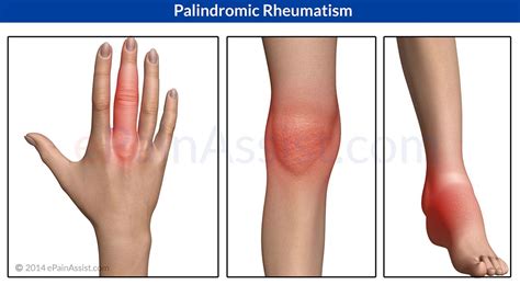 Rheumatism -- This is one of the afflictions listed from which the colonel suffered. Rheumatism ...