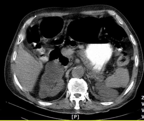 Multiple cortical cysts in both kidneys. One of the large cyst that ...