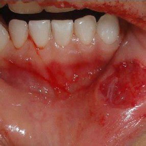 (PDF) ORAL MUCOCELE: A CASE REPORT