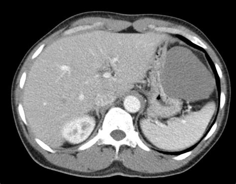 Hepatic Hemangioma is Exophytic in Location and Simulates a Gastric ...