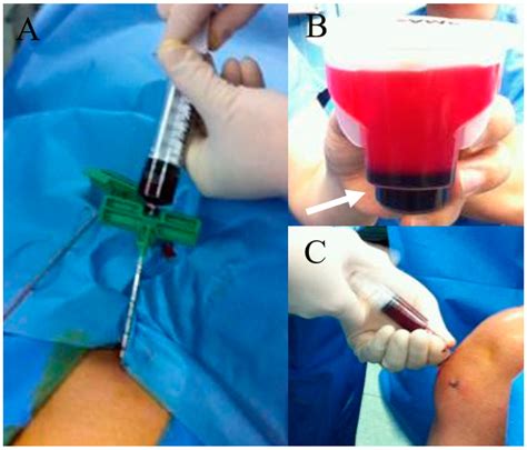 IJMS | Free Full-Text | Bone Marrow Aspirate Concentrate: Its Uses in ...