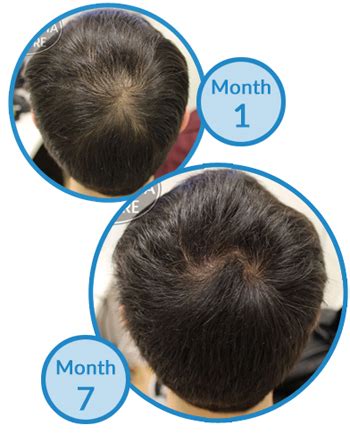 Is My Double Crown a Sign of Male Pattern Hair Loss?'