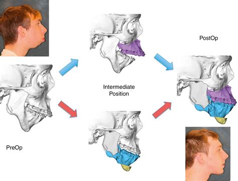 Maxillary–mandibular aesthetic orthognathic surgery | Plastic Surgery Key