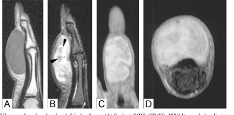 Figure 3 from MRI Findings of Giant Cell Tumor of Tendon Sheath and Other Benign Soft Tissue ...