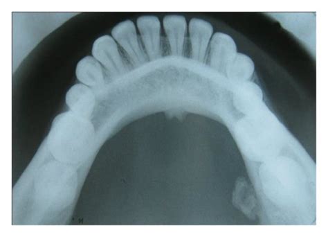 Mandibular occlusal cross-sectional radiograph. | Download Scientific ...