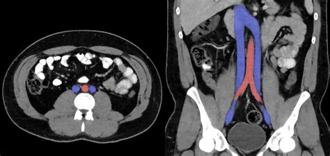 ivc blood clot filter What You Should Know