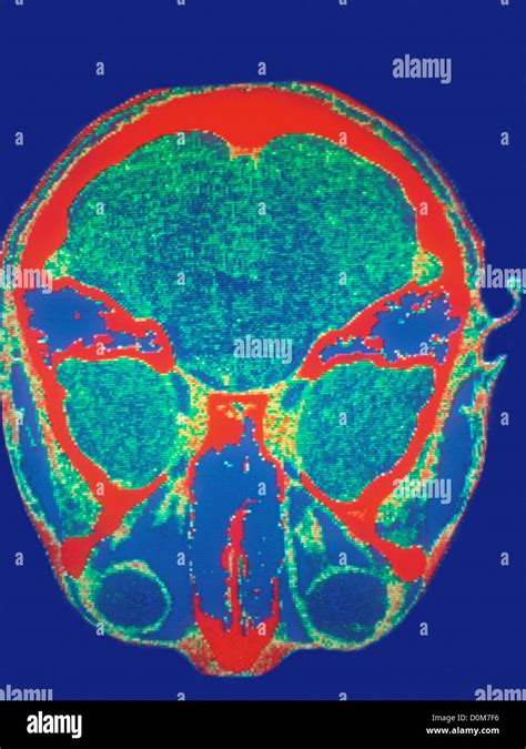 CAT Scan of Optic Nerve Lesion Stock Photo - Alamy