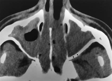 Noncontrast CT scan shows a single instance of softtissue attenuation... | Download Scientific ...