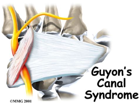 Carpal Tunnel Syndrome/Tennis Elbow and other similar problems and cures. | HubPages