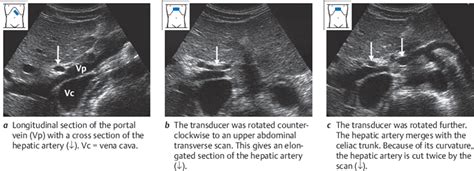 Porta Hepatis | Radiology Key