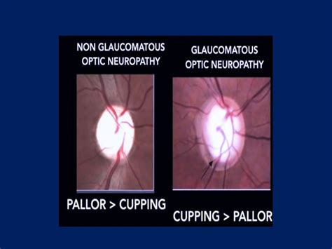 Clinical evaluation of optic disc changes