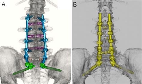 Combination of sacral-alar-iliac screw and cortical bone trajectory screw techniques for ...