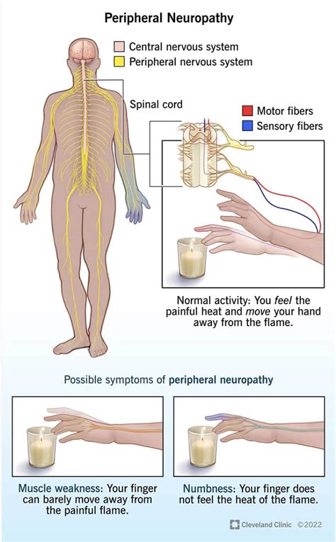 Finding your feet with peripheral neuropathy — Neurological ...