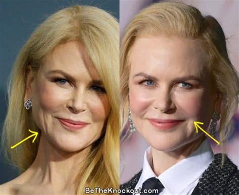 Nicole Kidman Plastic Surgery Comparison Photos