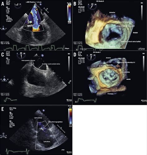 MitraClip intervention for severe mitral regurgitation with residual ...