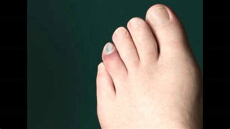 Swollen Toe Causes - YouTube