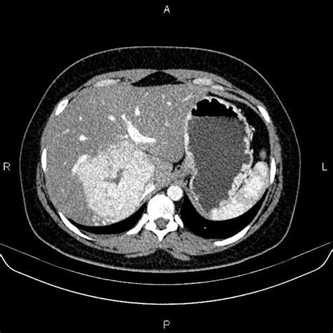 Focal Nodular Hyperplasia Liver - cloudshareinfo