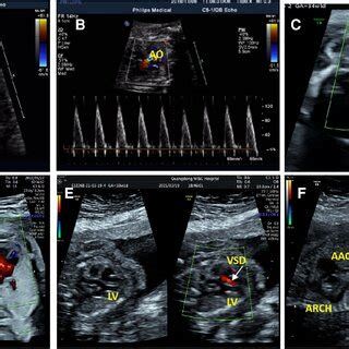 Less common ultrasound features in our study. (A) The ultrasonic ...