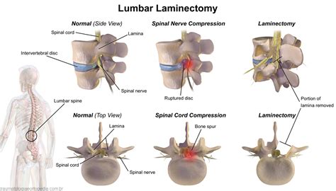 Laminotomia E Laminectomia - Traumatologia E Ortopedia