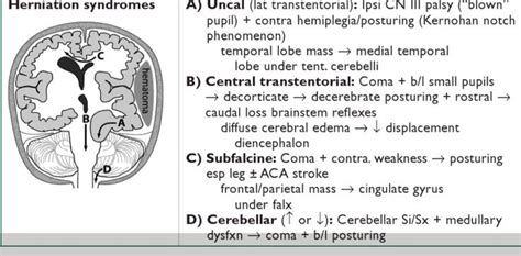 uncal herniation | brain herniation syndrome: Uncal herniation: clinical triad of (1 ...