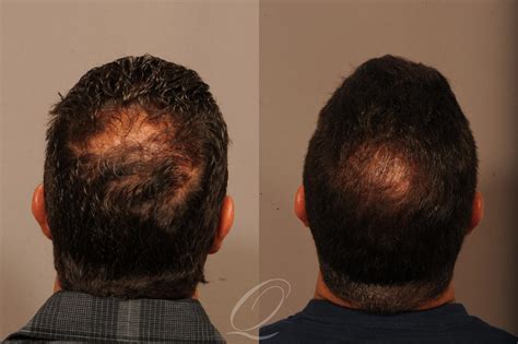 Male Crown Hair Restoration Before & After Photo Gallery | Rochester, Buffalo, & Syracuse, NY ...