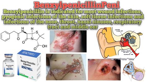 Benzyl penicillin || Penicillin G || Penicillin G Uses||How Penicillin ...