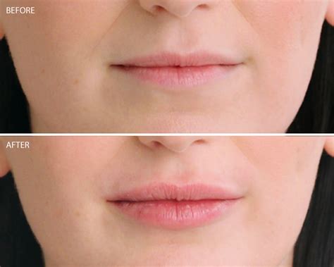 Restylane® Kysse - Lip Filler Irvine | Concierge Aesthetics, Orange County