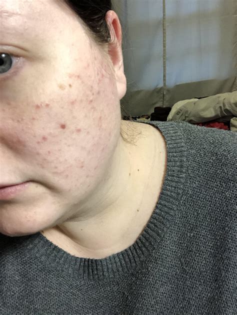 [acne]Pregnancy acne is the worst! : r/SkincareAddiction