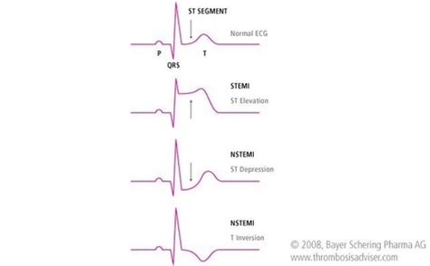 Critical Care Exam Cardio Hemodynamics Acs And Mi Flashcards Quizlet