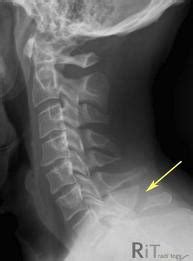 Cervical Thoracic Spine Flashcards Quizlet