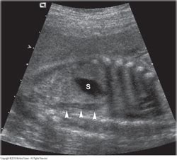 OB GYN Board Review Fetal GU System Fetal Pelvis Flashcards Quizlet