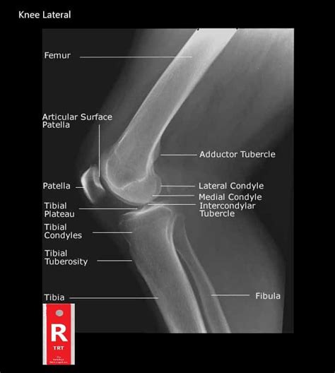 Common Knee Xray Findings A Comprehensive Guide To Normal Knee