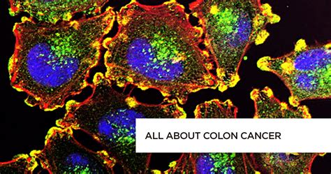 All About Colon Cancer Causes Symptoms Risk Factors