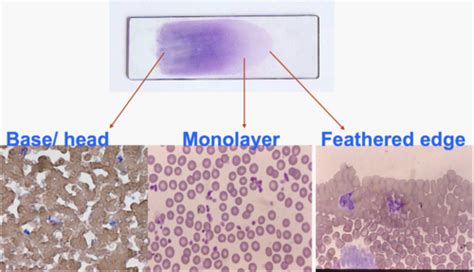 Diagnostic Significance Of Rbc Morphology Flashcards Quizlet