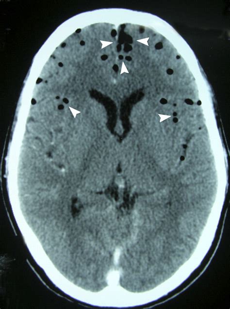 Pneumocephalus As A Complication Of Multidrug Resistant Klebsiella