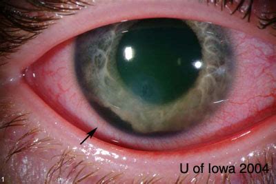 Ocular Trauma, assessment and management