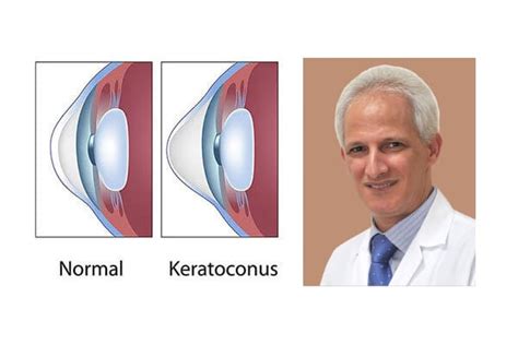 Five Treatment Options For Keratoconus Visionplus Magazine