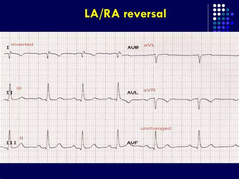 Ecg Limb Lead Reversal Ppt