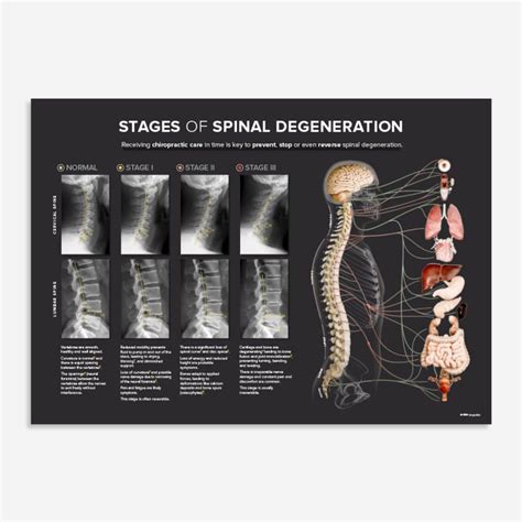 STAGES of SPINAL DEGENERATION '24 - Cx / Lx - Kirografiks