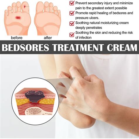 Bed Sore Cream,Bedsore Wound Care Cream,Pressure Sore Cream for Wound