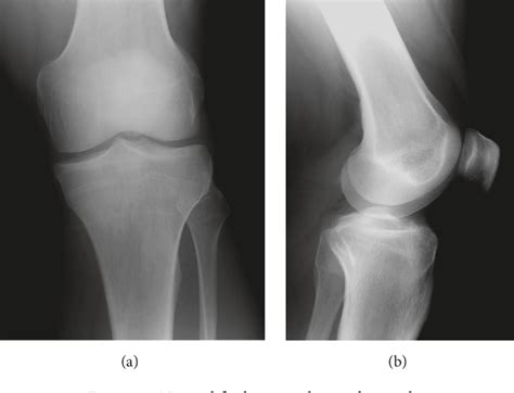 Figure 1 From Intra Articular Osteoid Osteoma As A Cause Of