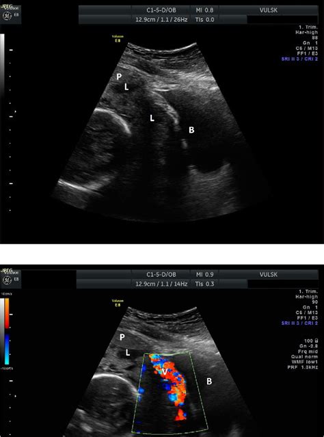 Figure 1 From Antenatal Diagnostic Aspects Of Placenta Percreta And Its Influence On The