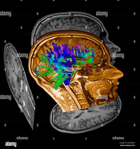 Tumor Cerebral D En Color De Im Genes De Tensor De Difusi N Dti E