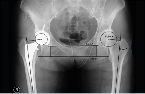 Scielo Brasil Ligament Preserving Total Hip Arthroplasty Prevents